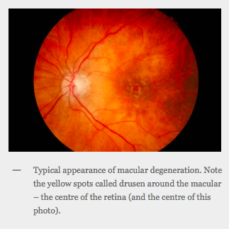 Typical appearance of macular degeneration. Note the yellow spots called drusen around the macular – the centre of the retina (and the centre of this photo).